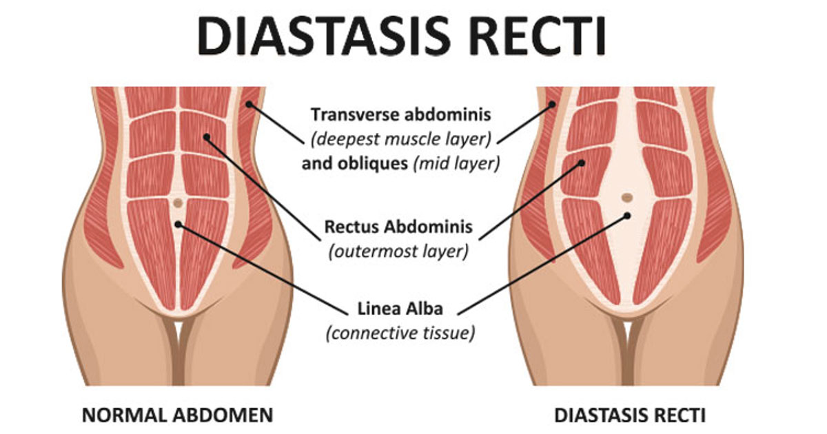 rectus abdominis stretch