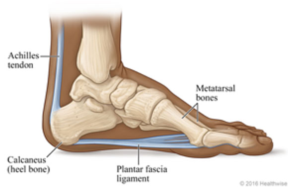 Plantar fasciitis / plantar fasciopathy - a common cause of foot pain ...